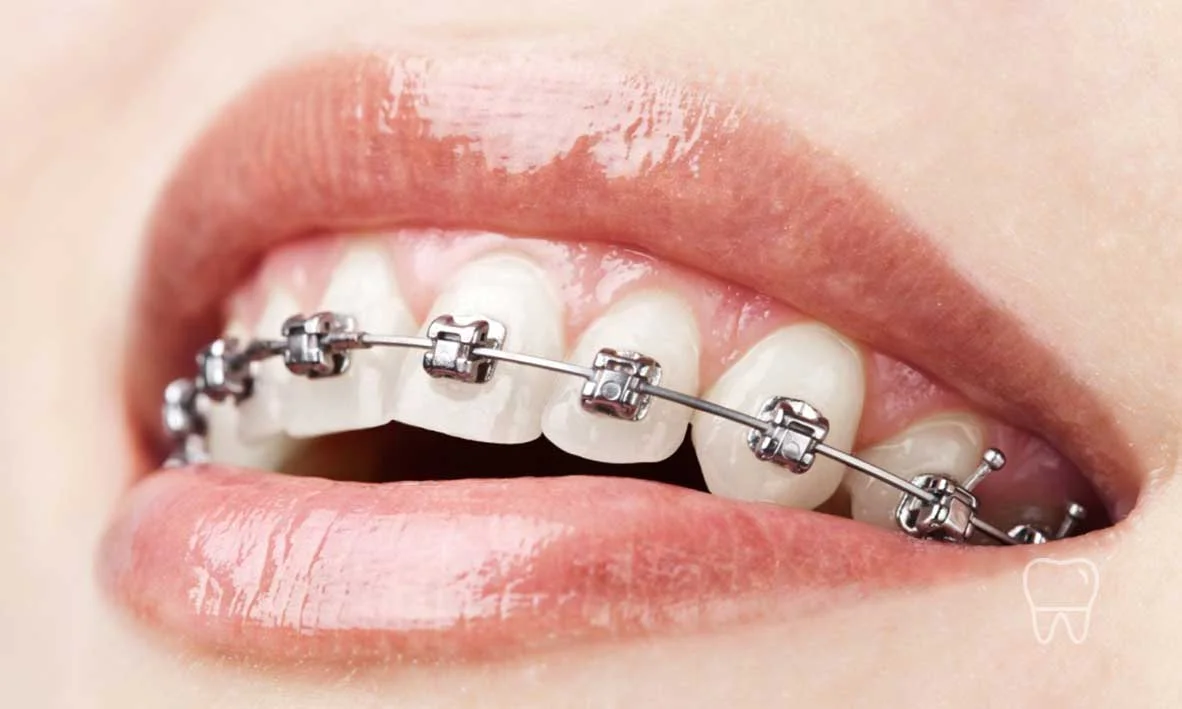 Braces